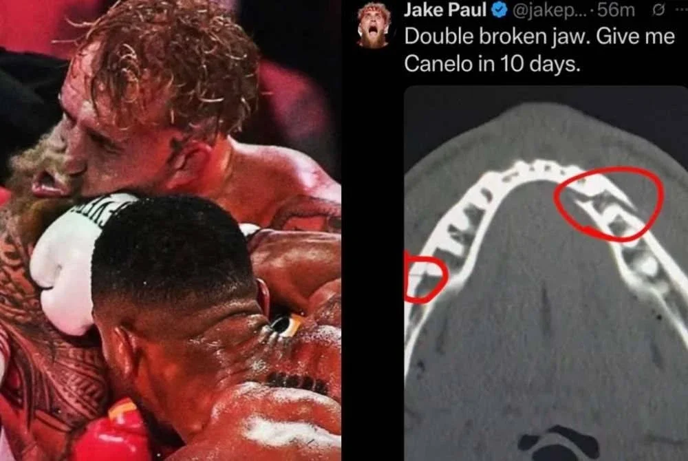 Imbasan x-ray menunjukkan rahang Jake Paul patah di dua tempat selepas menerima tumbukan padu bekas juara dunia heavyweight Anthony Joshua. FOTO: Agensi