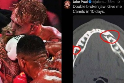 Imbasan x-ray menunjukkan rahang Jake Paul patah di dua tempat selepas menerima tumbukan padu bekas juara dunia heavyweight Anthony Joshua. FOTO: Agensi