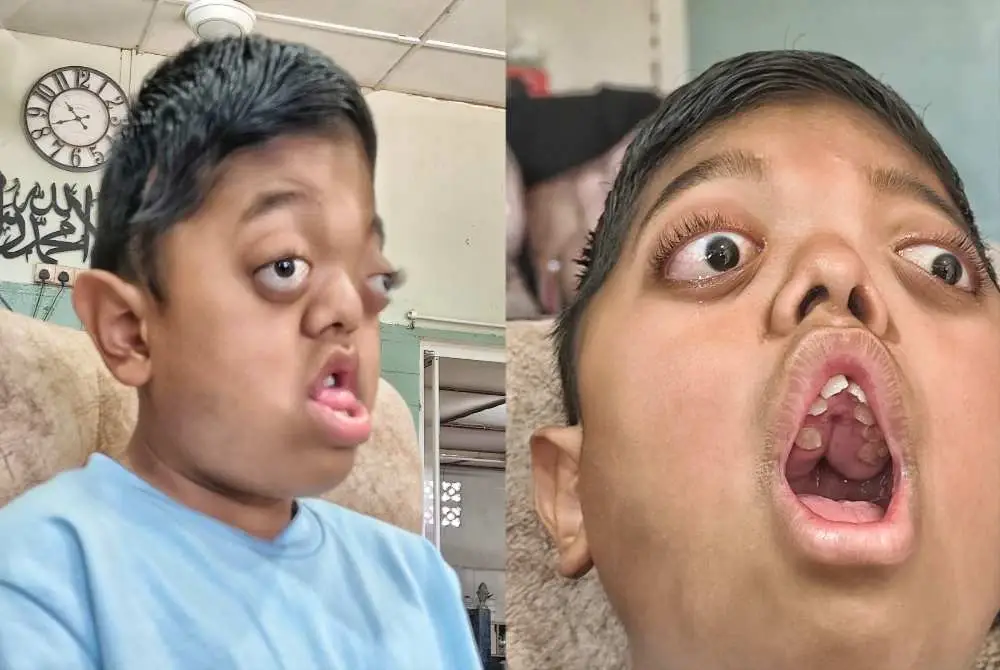 Muhammad Niyaz Furqan lahir dengan kecacatan fizikal pada struktur muka dan tengkorak kepala, sekali gus menjejaskan pernafasan dan penglihatannya.