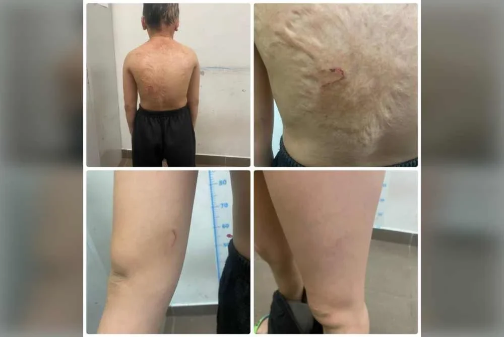 Kesan cedera pada badan mangsa. Foto ihsan polis