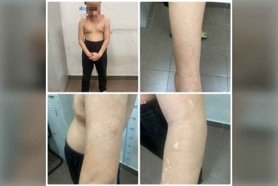 Kesan cedera pada badan mangsa. Foto ihsan polis