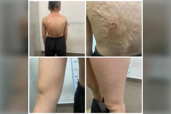 Kesan cedera pada badan mangsa. Foto ihsan polis