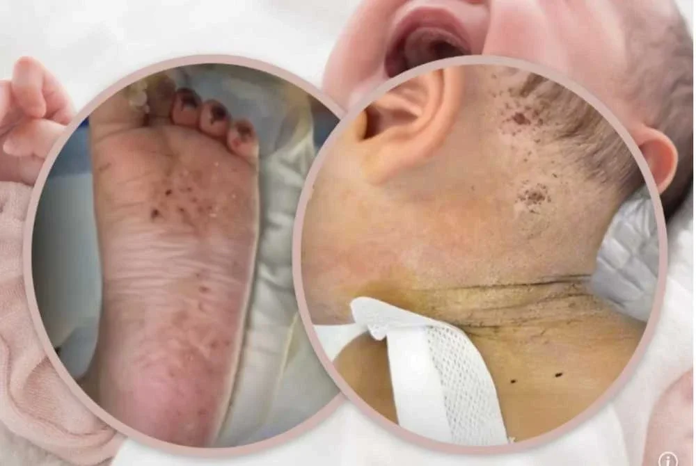 Kesan jarum di telapak kaki, tengkuk dan kepala bayi berkenaan. FOTO: Agensi