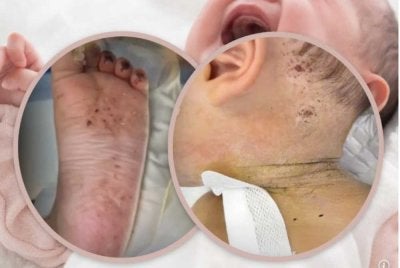 Kesan jarum di telapak kaki, tengkuk dan kepala bayi berkenaan. FOTO: Agensi