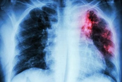 Sebanyak 503 kes baharu tuberkulosis atau tibi dikesan di seluruh negara sehingga Minggu Epidemiologi kelima tahun ini (ME 5/2026) menjadikan bilangan keseluruhan kes kepada 2,571 setakat ini. Gambar hiasan. 