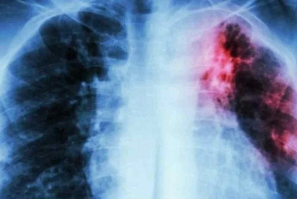 Tibi boleh membawa maut jika pesakit gagal mendapatkan rawatan awal. Gambar hiasan