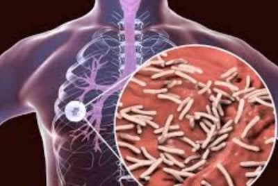 Peningkatan kes tuberkulosis di Malaysia memerlukan perhatian serius daripada semua pihak. Gambar hiasan 