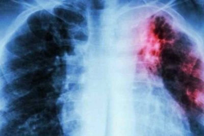 Tibi boleh membawa maut jika pesakit gagal mendapatkan rawatan awal. Gambar hiasan