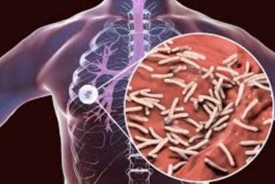 Penyakit tibi merebak melalui udara dan boleh merosakkan paru-paru serta organ lain jika tidak dirawat awal. Gambar hiasan 