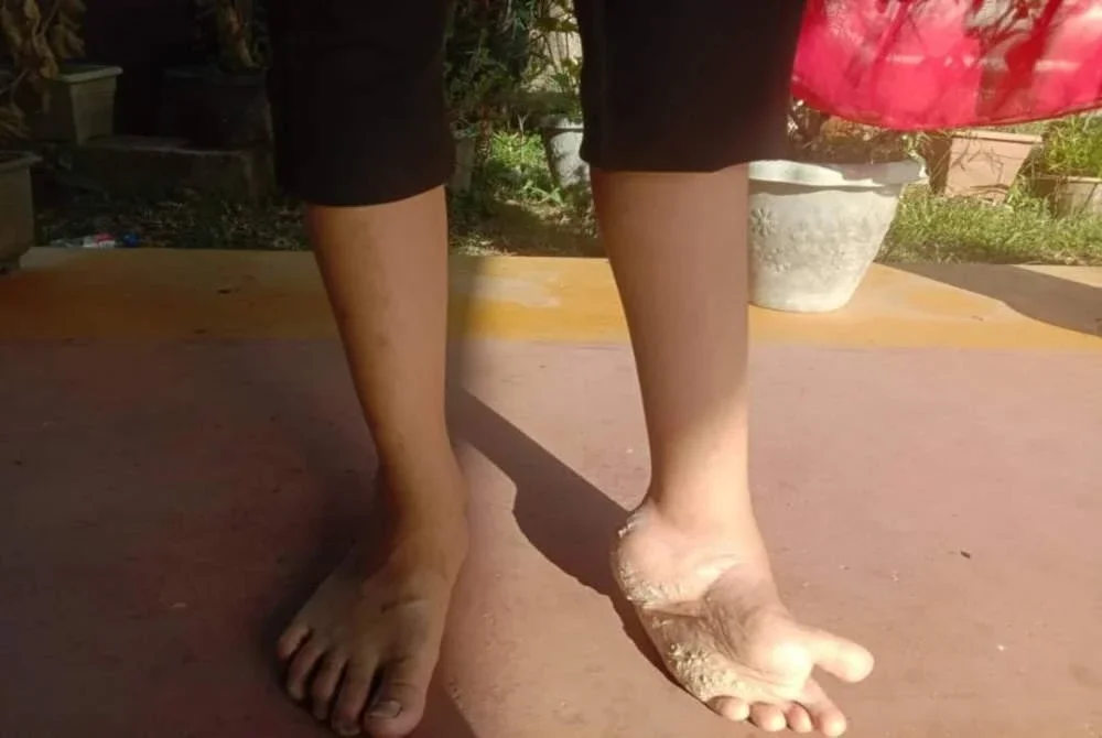 Muhammad Iftar Syawal Mohd Zafardi memerlukan pembedahan memasukkan besi sokongan pada tulang dengan anggaran kos kira-kira RM28,000.