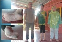 Muhammad Iftar Syawal (tengah) bersama kedua ibu bapanya. Gambar kecil: Tapak kaki kiri Muhammad Iftar Syawal sering mengalami kematu dan berdarah.