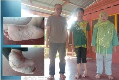 Muhammad Iftar Syawal (tengah) bersama kedua ibu bapanya. Gambar kecil: Tapak kaki kiri Muhammad Iftar Syawal sering mengalami kematu dan berdarah.