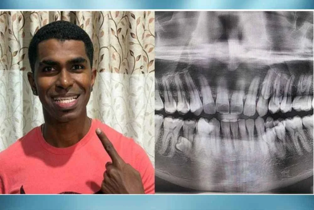 Prathab Muniandy, 33, memiliki 42 batang gigi.