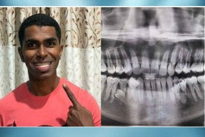 Prathab Muniandy, 33, memiliki 42 batang gigi.