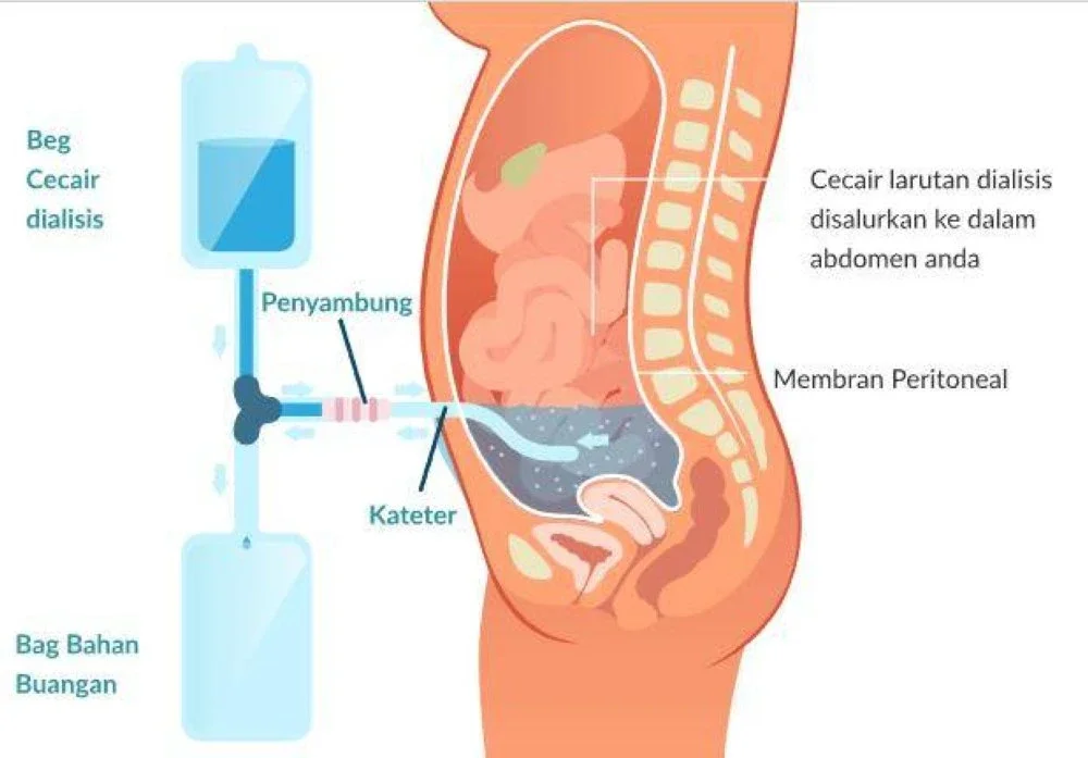 Gambaran proses rawatan peritoneal dialysis. Sumber: Yayasan Buah Pinggang Malaysia / National Kidney Foundation Malaysia.
