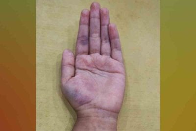 Satu hantaran oleh seorang wanita di Facebook tular apabila mendakwa anak lelakinya yang bersekolah di Tahun Dua dipukul menggunakan pembaris kayu sehingga menyebabkan jari murid terbabit bengkak. 