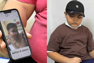 Keadaan pipi Isaac sewaktu mula penyakitnya dikesan dan kini semakin sihat namun masih menjalani pemeriksaan rawatan susulan bagi memastikan keadaannya pulih sepenuhnya