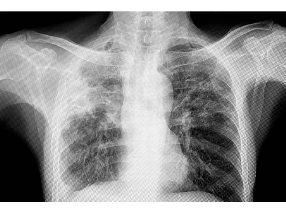 X-ray dada menunjukkan tibi paru-paru dengan penglibatan utama di lobus atas, yang boleh melibatkan paru-paru kiri, kanan, atau kedua-duanya.