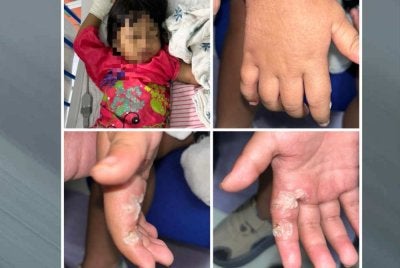 Mangsa yang mengalami kecederaan melecur pada jari telunjuk kanan ditempatkan di wad HTJ