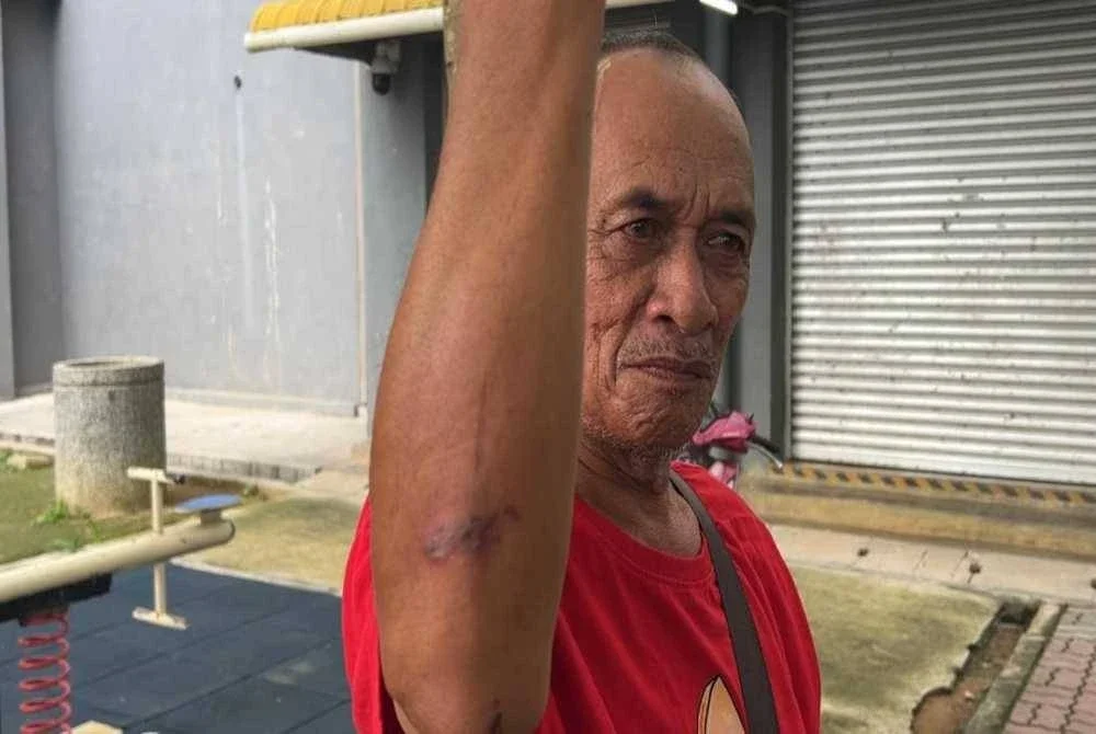 Penduduk menunjukkan bekas gigitan semut charlie yang meninggalkan kesan gatal dan bengkak.