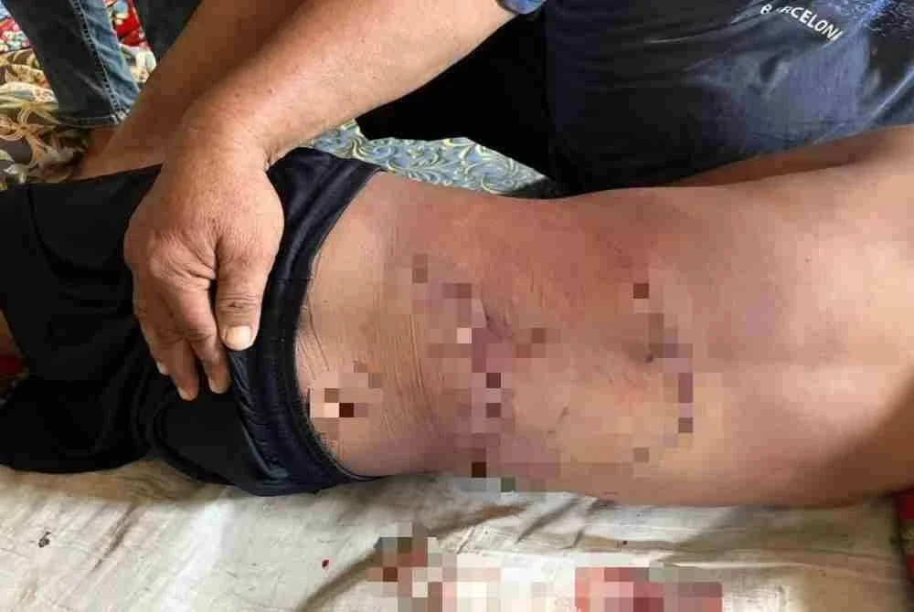 Kesan gigitan buaya pada tubuh kanak-kanak lelaki yang ditemukan maut dalam kejadian di sungai Dent Heaven Kampung Tagupi, Lahad Datu.