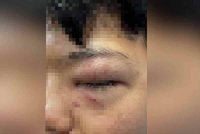Hampir hilang penglihatan kerana kepercayaan tradisional