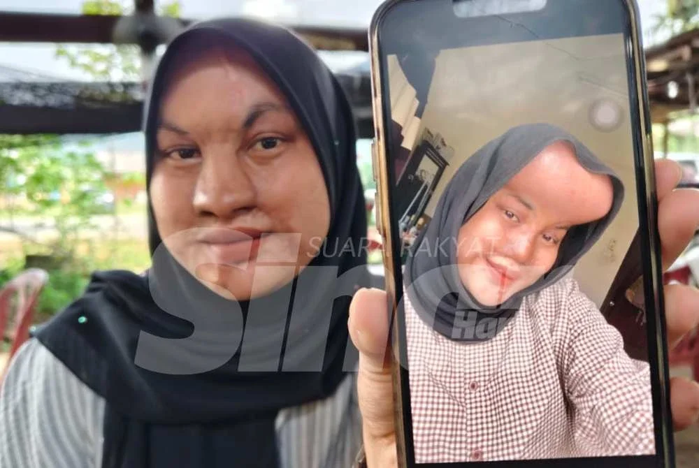Nurul Dahyatul Fazlinda menunjukkan wajahnya ketika menjalani pembedahan memasukkan tisu expander dengan cara menebuk bahagian atas dahi.