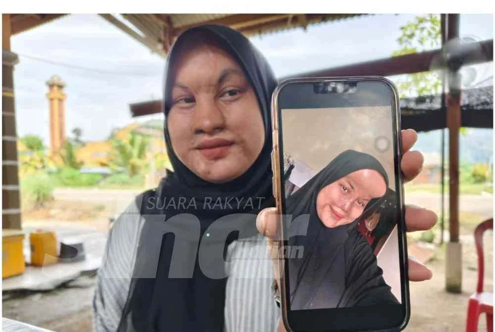 Menurutnya, proses rawatan dijangka masih mengambil masa beberapa tahun sebelum keadaan wajahnya benar-benar stabil.