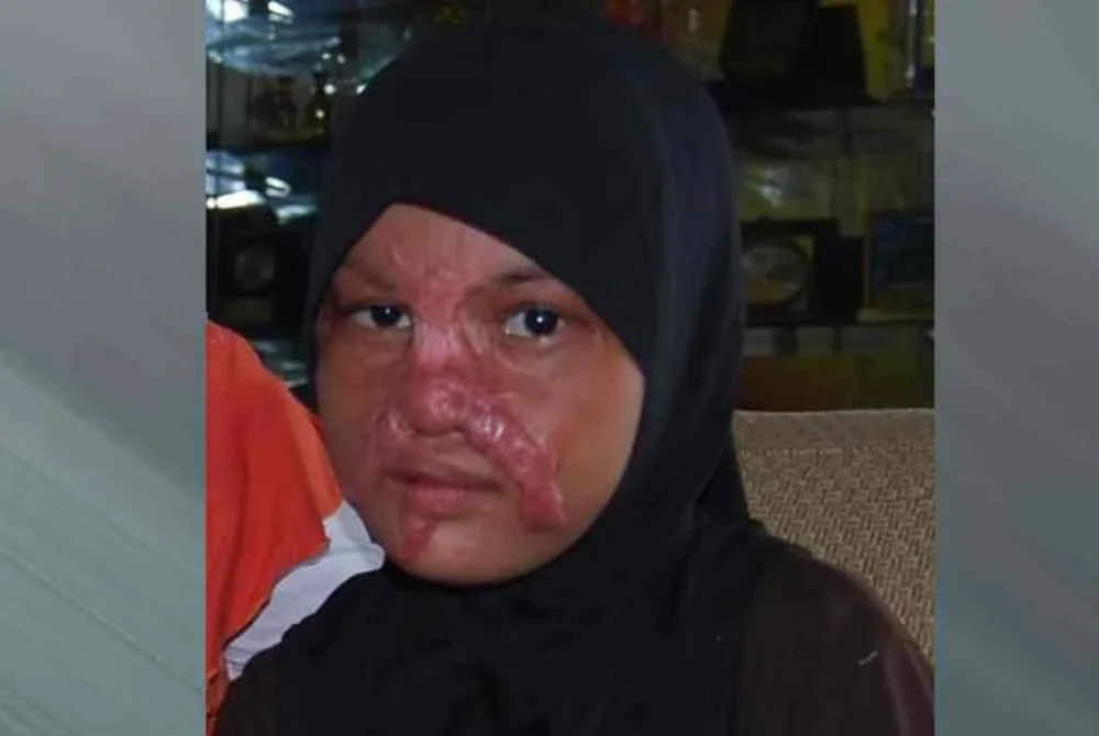 Peristiwa pada awal pagi 15 Ogos 2010 itu bukan sahaja meninggalkan parut kekal pada wajah gadis yang mesra disapa Lin itu, malah menjadikan Hospital Kuala Lumpur (HKL) seolah-olah ‘rumah kedua’ sepanjang proses pemulihannya.