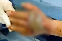 Mangsa juga mengalami gejala sistemik akibat bisa ular tedung itu. Foto Agensi