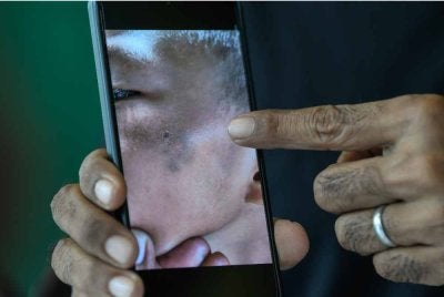 Kesan lebam pada bahagian mata sebelah kiri kanak-kanak berusia sembilan tahun selepas menjadi mangsa buli pelajar senior berusia 15 tahun di sekolahnya sehingga mengalami lebam di beberapa bahagian badan dan muka. Foto Bernama 