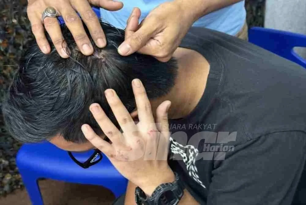 Luka yang dialami di kepala selepas dilanggar. FOTO: ADILA SHARINNI WAHID