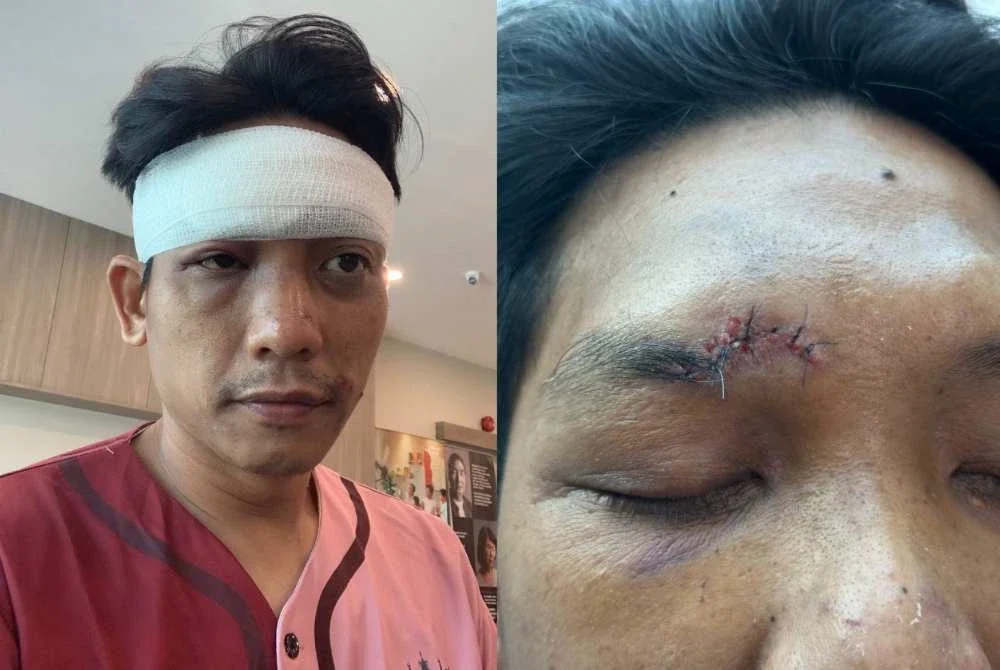 Mohd Shafiq menerima 10 jahitan pada bahagian dahi selepas terjatuh daripada basikal semasa beriadah di taman.