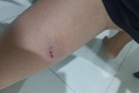 Kesan gigitan anjing liar pada kaki kiri mangsa.