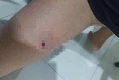  Seorang pelajar Tingkatan Satu cedera pada kaki kiri selepas digigit seekor anjing liar ketika dalam perjalanan ke sekolah di Krubong.