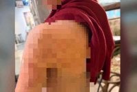 Keadaan badan murid lelaki berusia sembilan tahun yang didakwa dicederakan seorang guru di sebuah sekolah rendah di daerah Barat Daya, pada 8 September lalu.