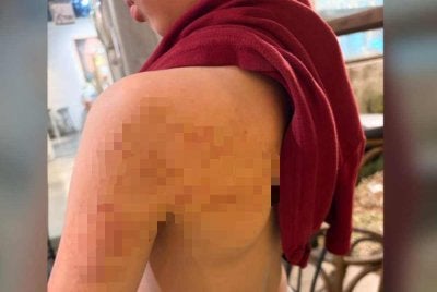 Keadaan badan murid lelaki berusia sembilan tahun yang didakwa dicederakan seorang guru di sebuah sekolah rendah Cina di daerah Barat Daya, pada 8 September lalu.