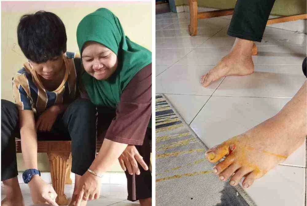 Keadaan kaki Alif yang cedera akibat digit anjing liar di Kawasan Perumahan Rakyat Lima Kedai, Iskandar Puteri.