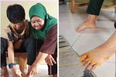 Keadaan kaki Alif yang cedera akibat digit anjing liar di Kawasan Perumahan Rakyat Lima Kedai, Iskandar Puteri.